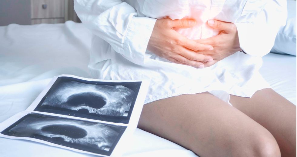 Efectos colaterales de la endometriosis