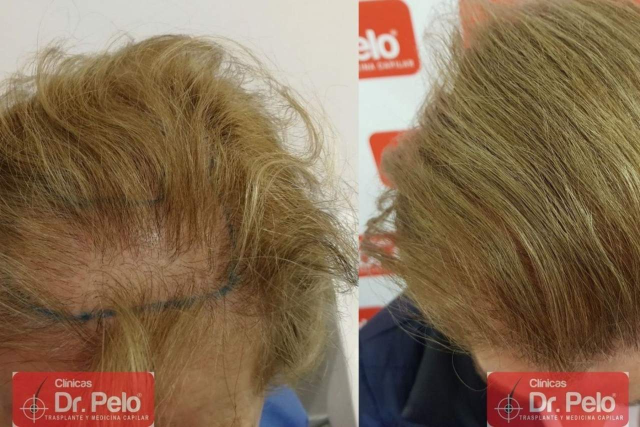 ¿Cómo es el injerto capilar en Sevilla en la Clínica Dr. Pelo?