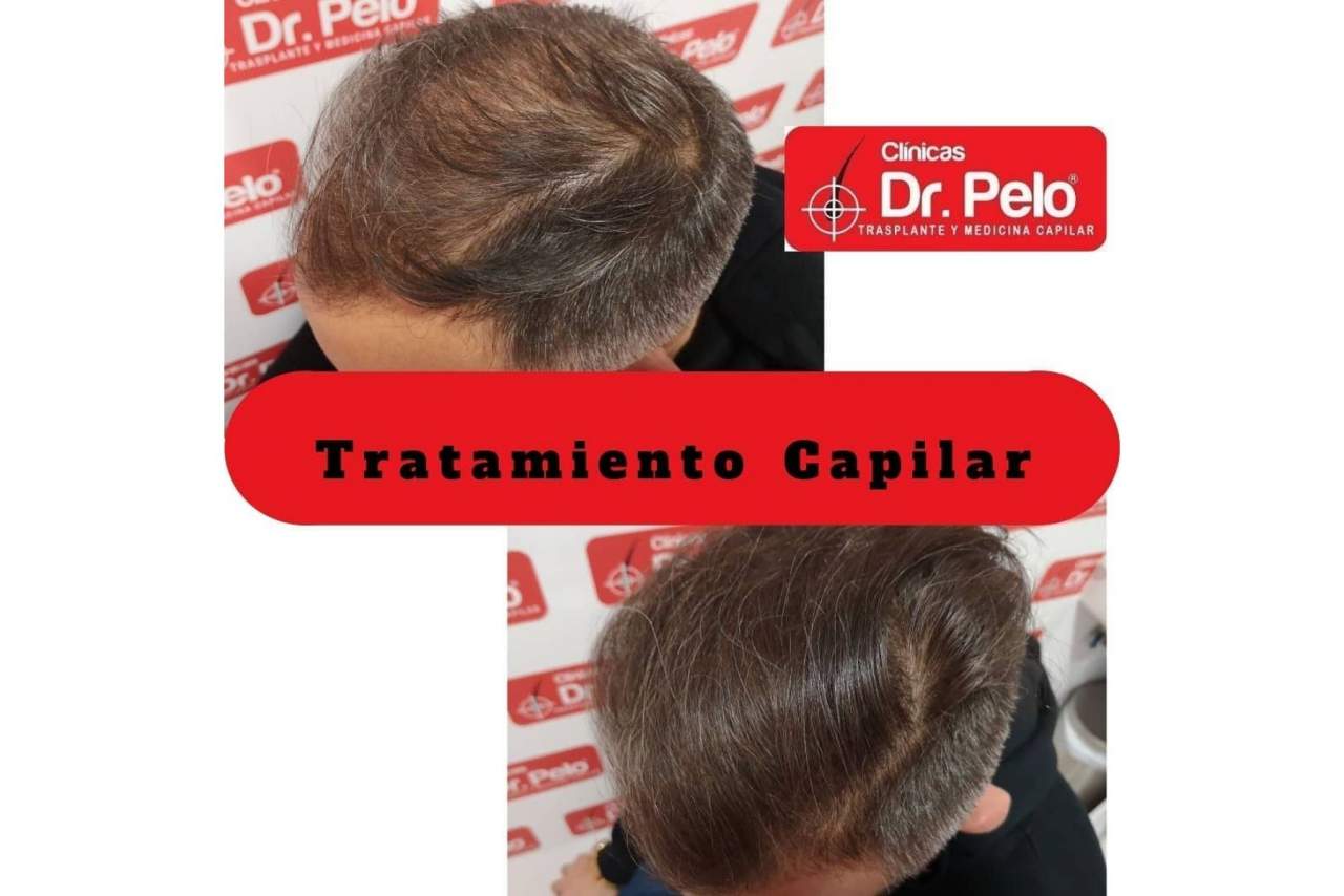 ¿Cuáles son las opiniones sobre el injerto capilar de las Clínicas Dr. Pelo en Sevilla?