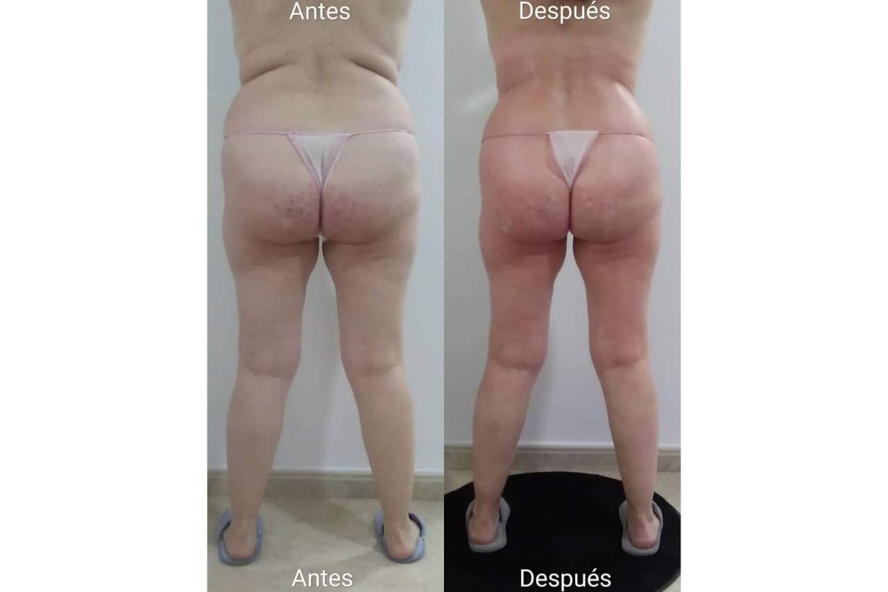 El tratamiento reductor en Valencia Triple R, diseñado por Vanesa Vendrell