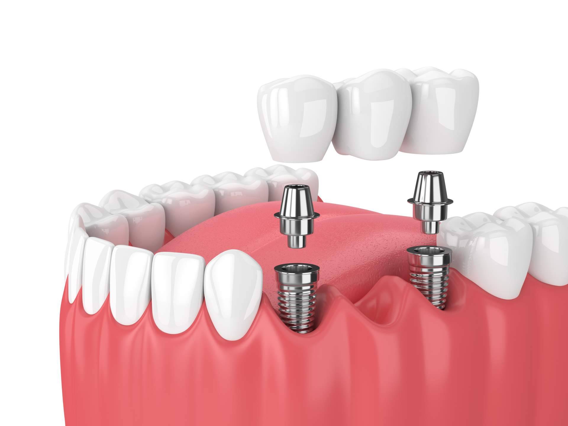 Implante dental de titanio en la Clínica de Odontología Artydents de Madrid por solo 199€