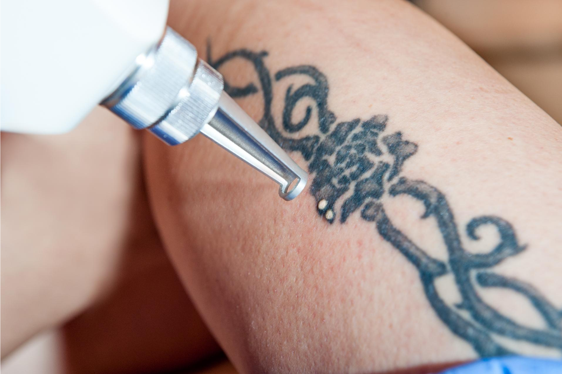 Yag Láser para eliminar tatuajes  por Bodyslim