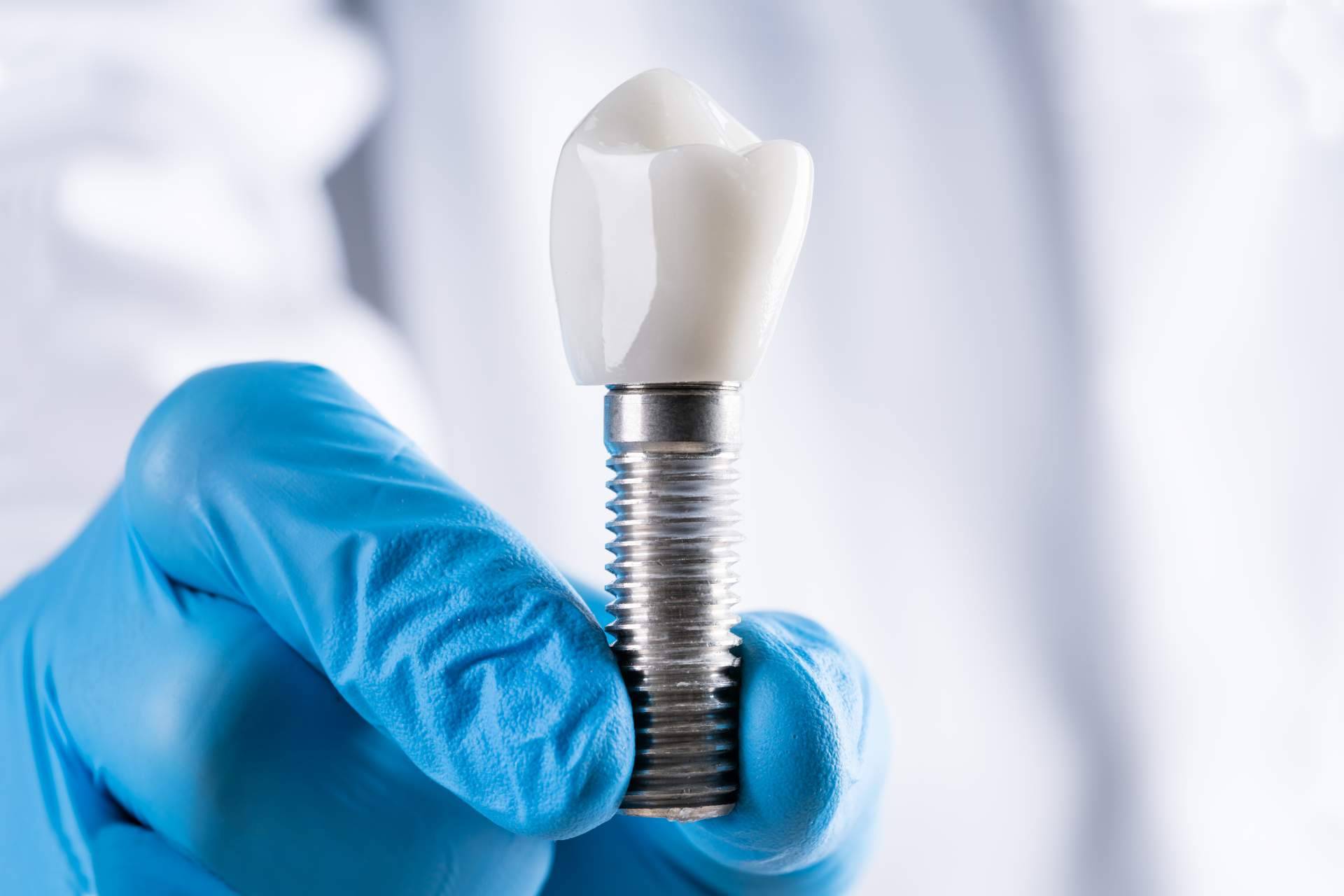Tener dientes fijos en un solo día es posible gracias a los implantes dentales de titanio V de la Clínica Artydents en Madrid