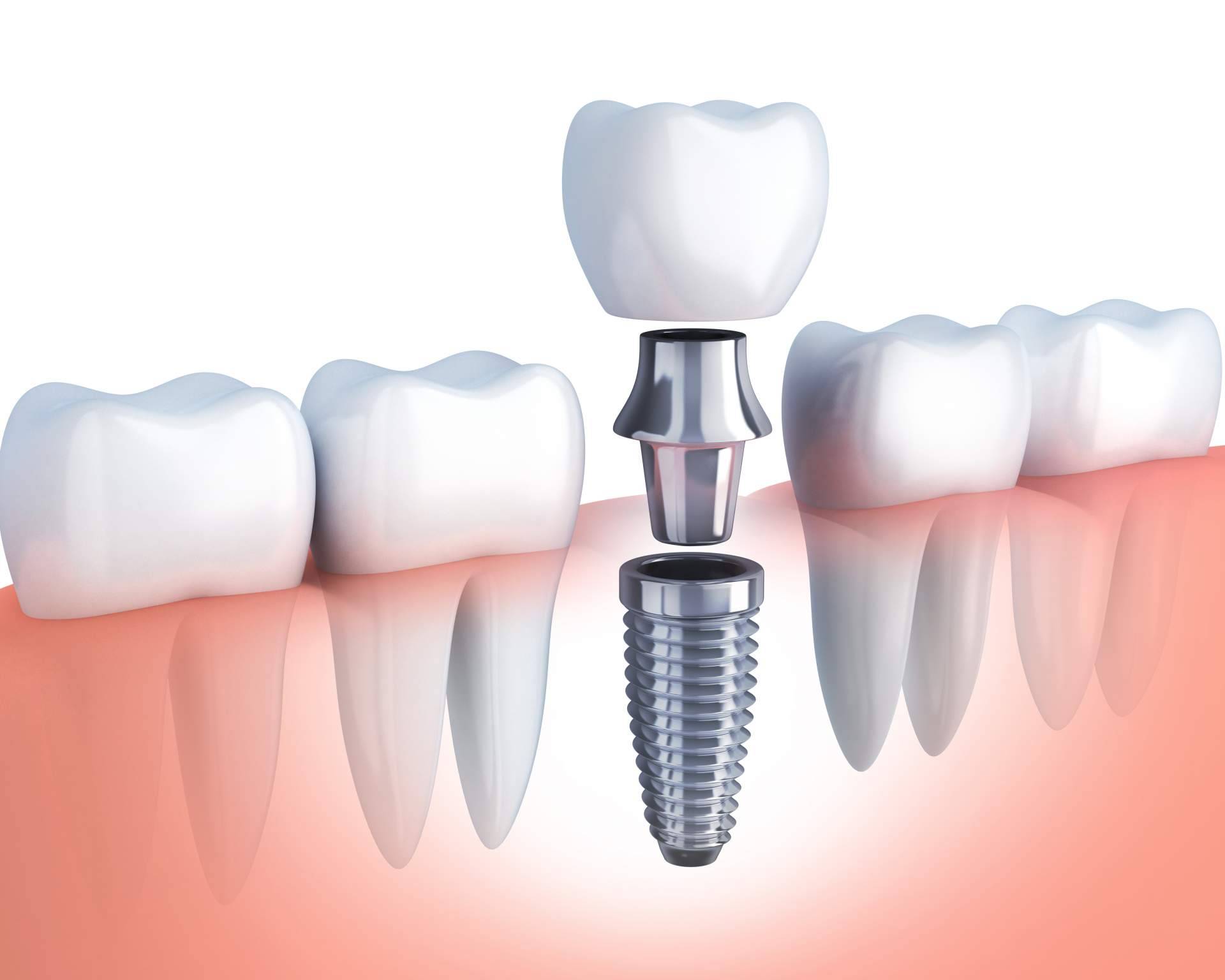 El implante dental de titanio V es uno de los tratamientos estrella de la Clínica Artydents en Madrid