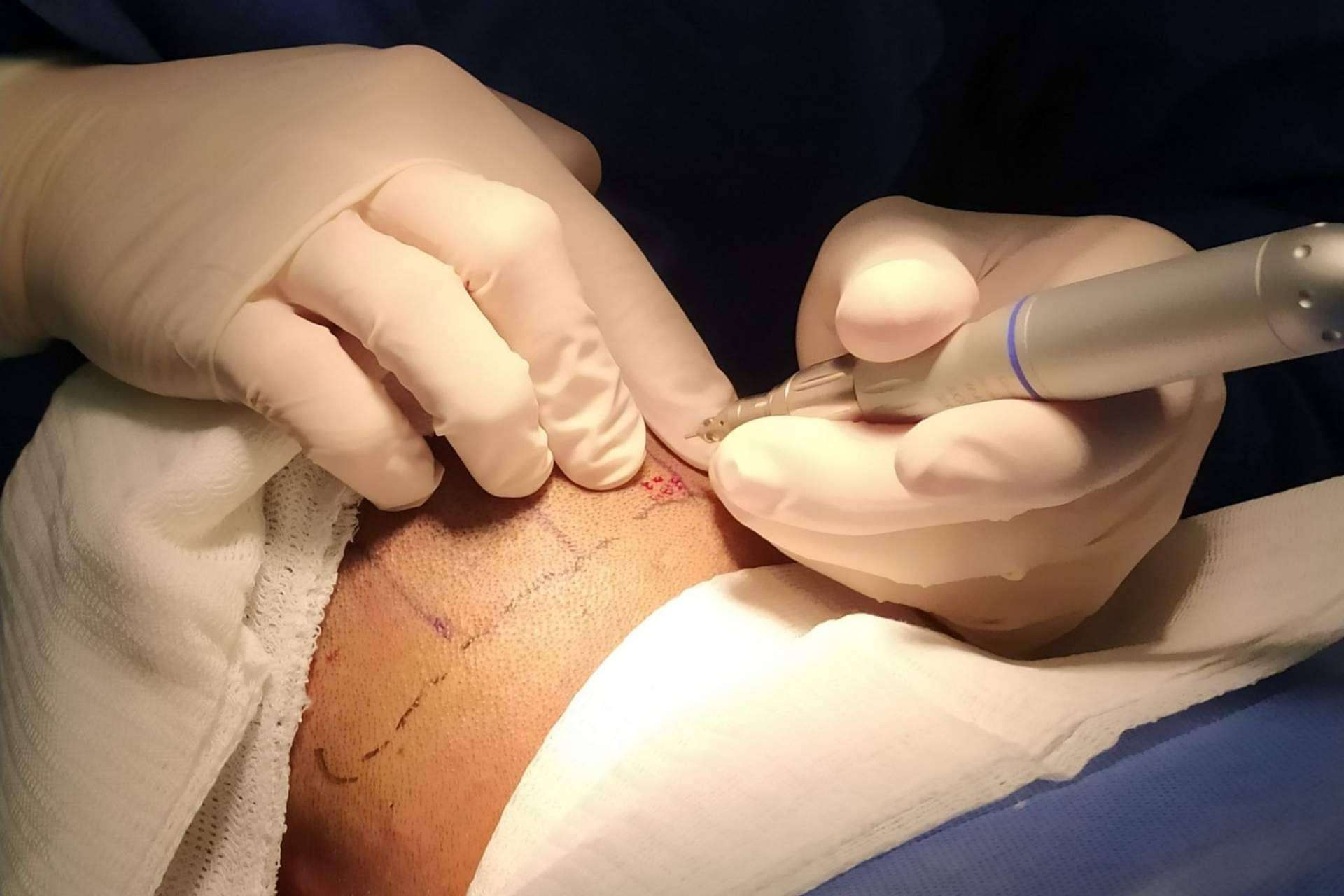 La clínica estética de Alcobendas, Clínica Tarrazo, realiza el microinjerto capilar