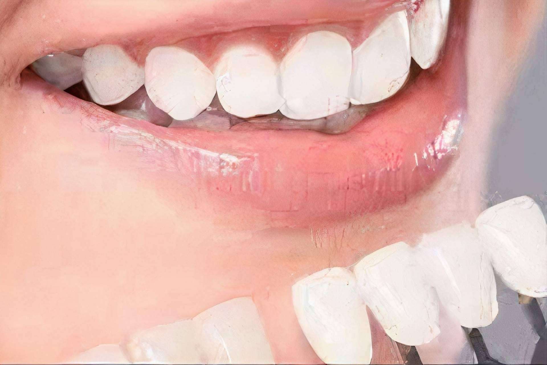 Implant Clinics: expertos en el blanqueamiento dental de calidad