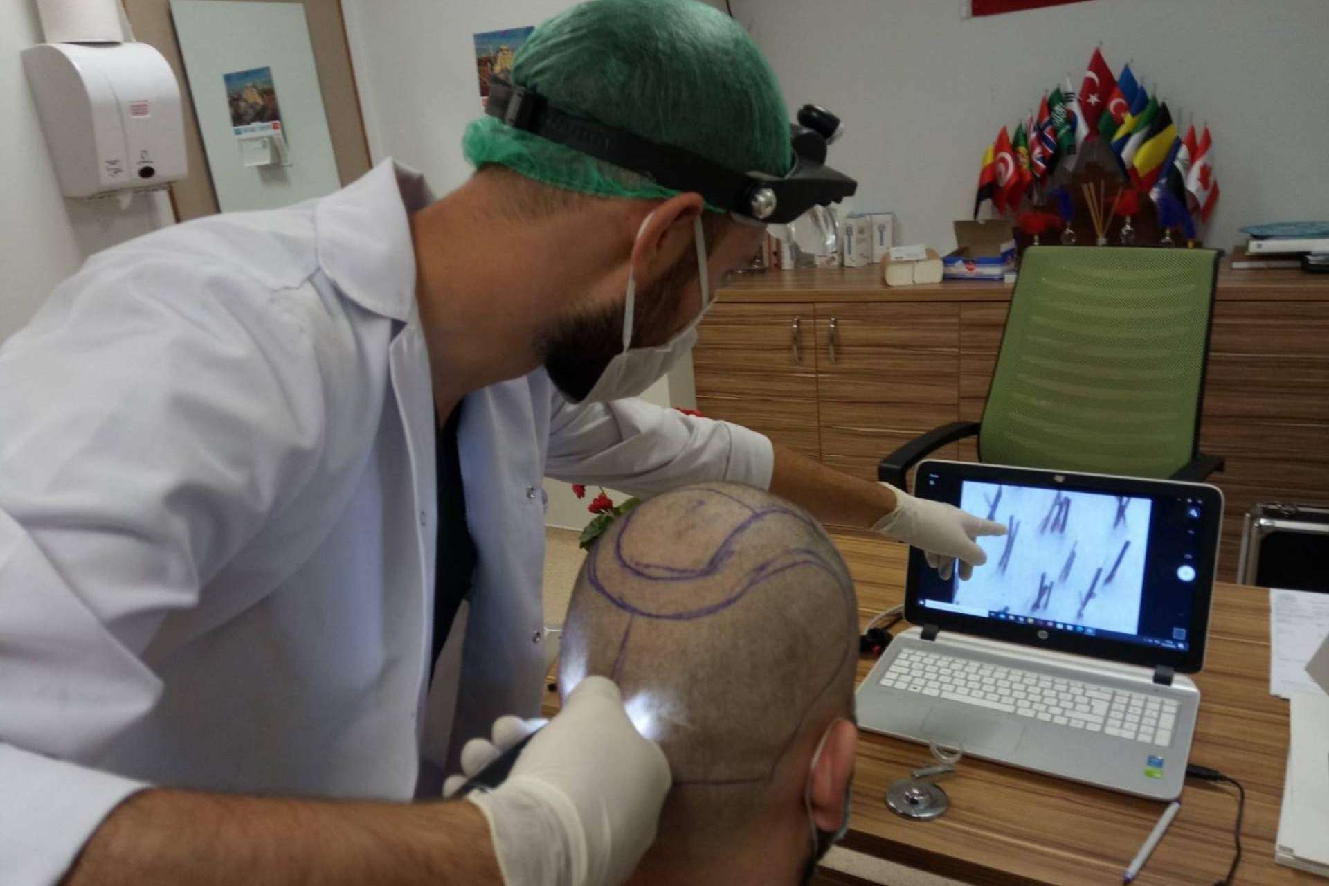 FUE Hair Transplant System realiza injerto capilar Turquía todo incluido