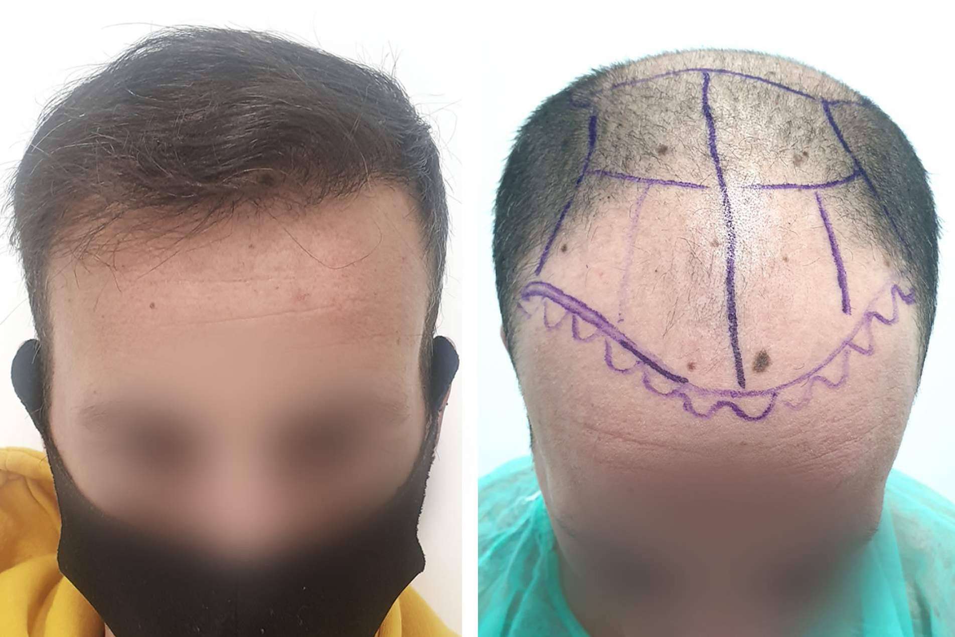 Injermur ofrece una técnica de injerto capilar que permite operaciones sin cicatriz