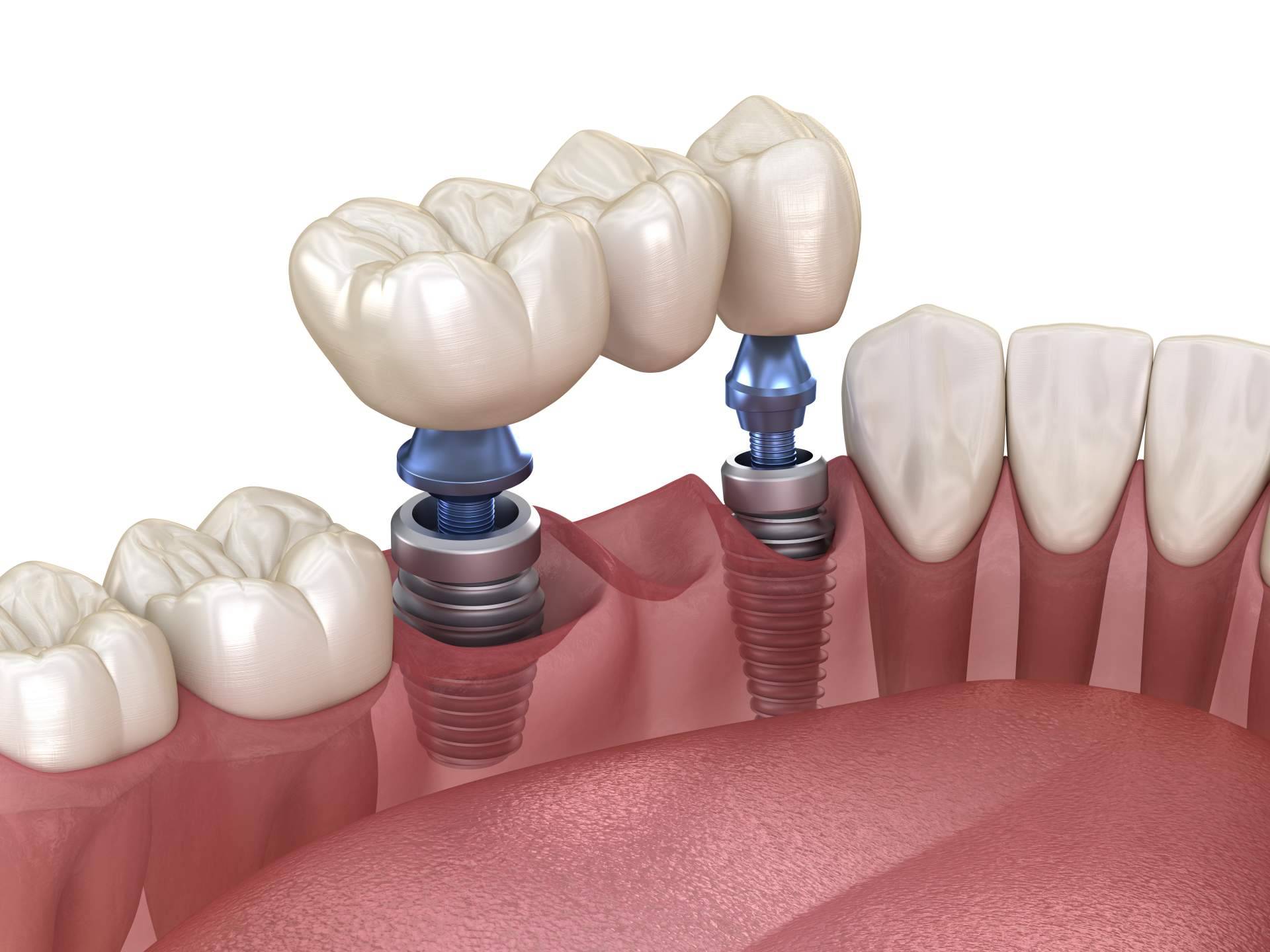 La Clínica Dental Helident realiza el tratamiento de implante dental de titanio en Sevilla