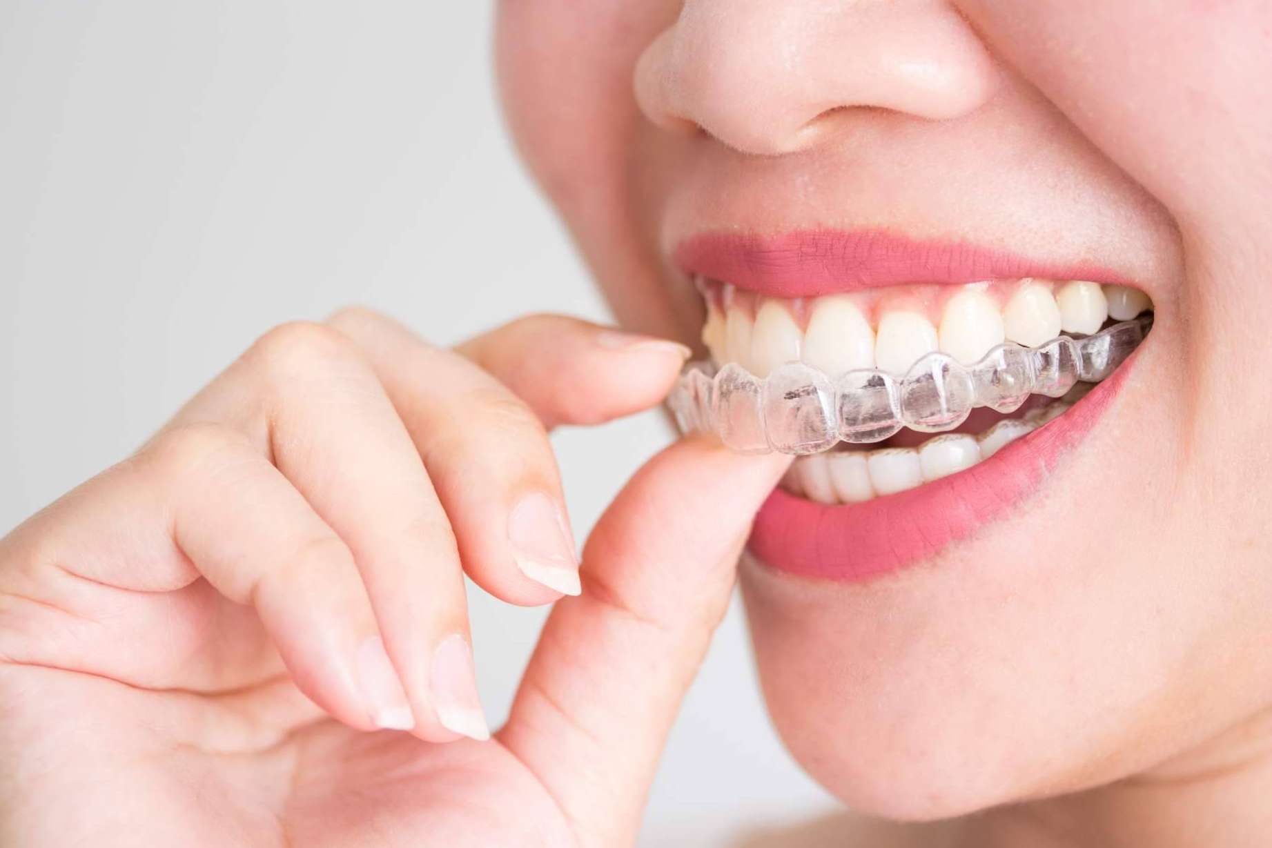 Helident Clínica Dental pone a disposición múltiples opciones de tratamiento de ortodoncia con brackets