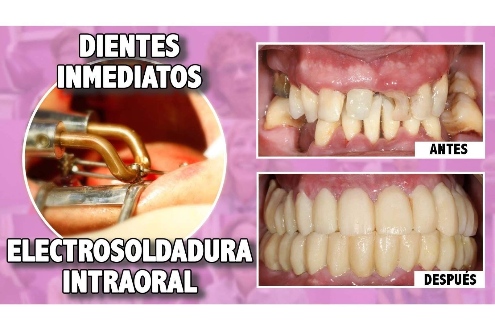 El Dr. Ismael Soriano realiza una técnica de implantes con dientes inmediatos que brinda múltiples beneficios a los pacientes