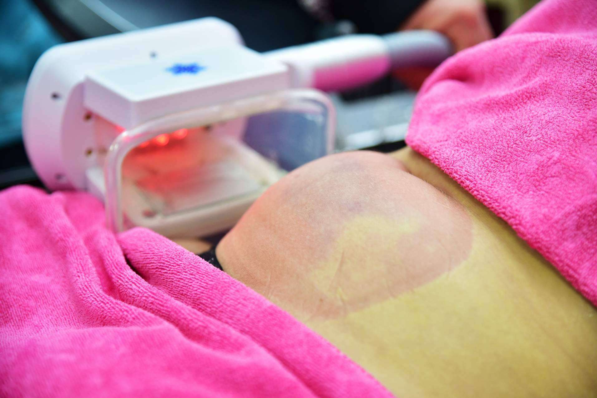 ¿Comporta la criolipolisis algún peligro para los pacientes? Por Unidad Femme