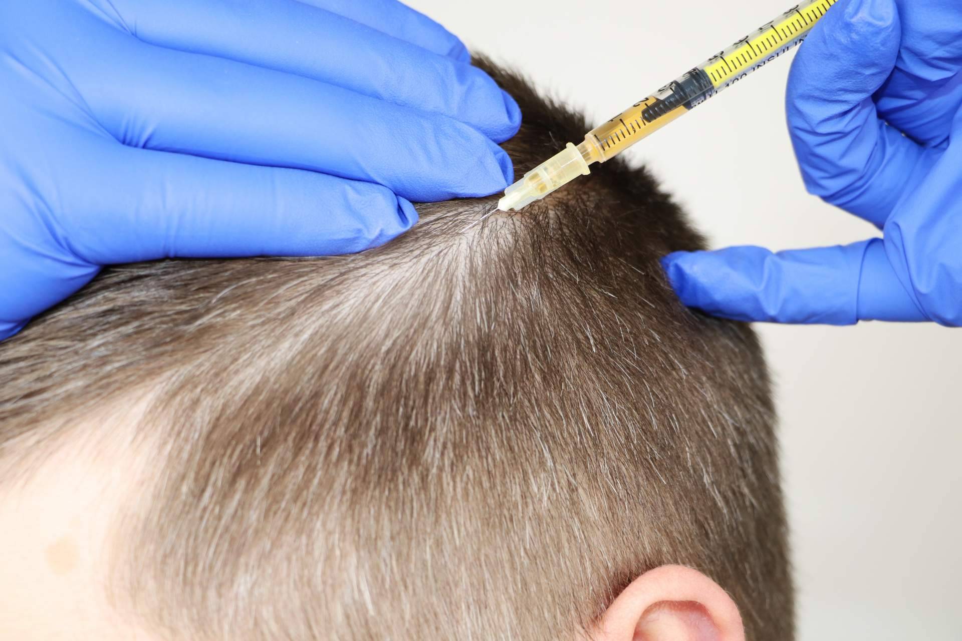 ¿Cuáles son los beneficios de la mesoterapia capilar realizada por el Dr. Bruno Jacobovski?