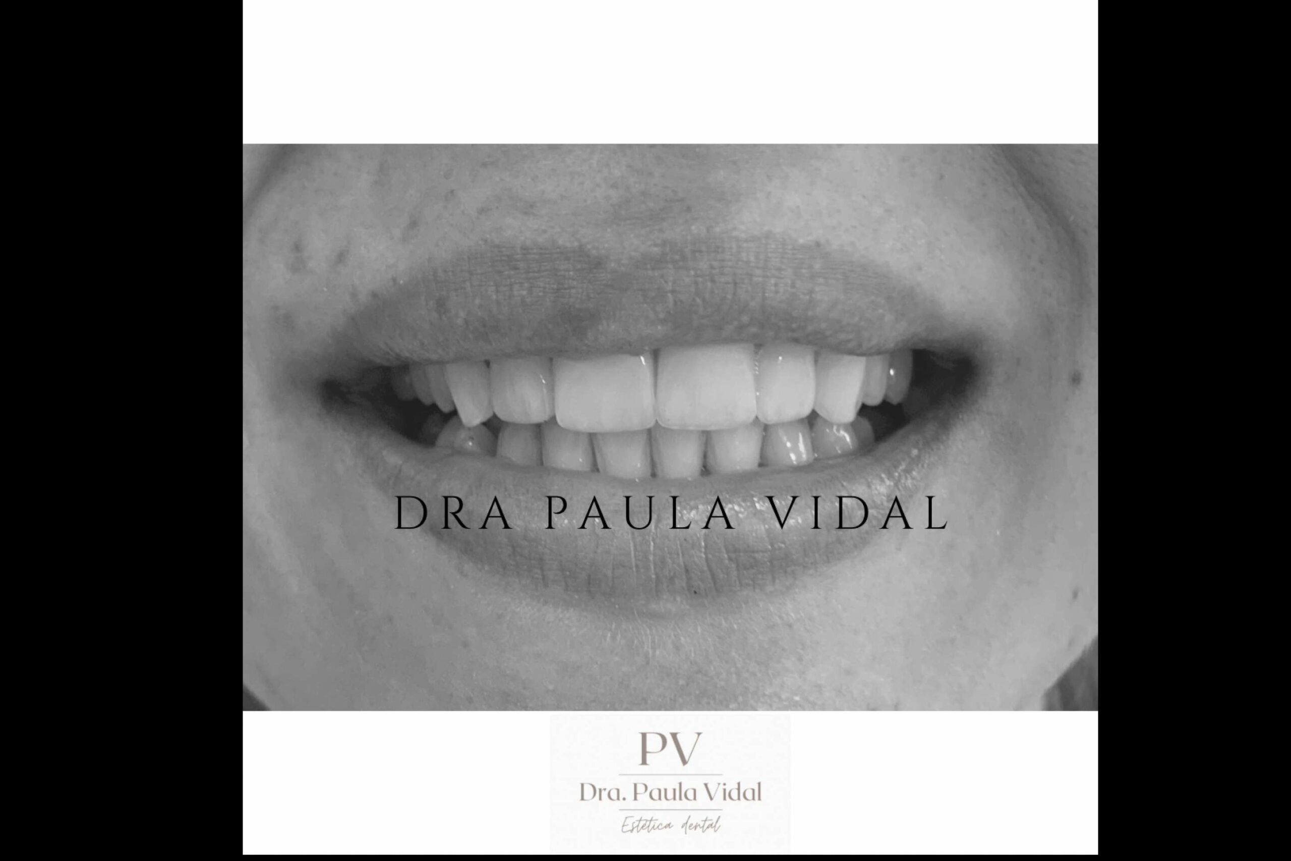 La Clínica Paula Vidal dispone de un servicio de carillas dentales