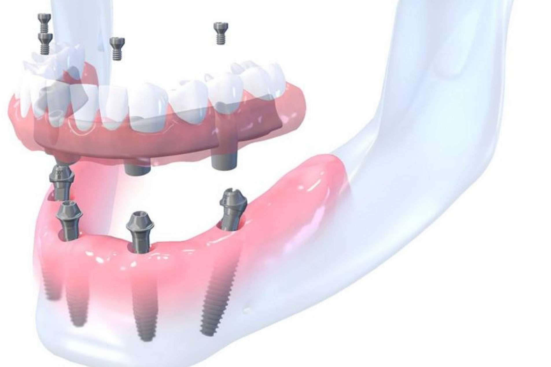 La clínica dental en Madrid Bordonclinic lleva a cabo rehabilitaciones orales complejas en un día