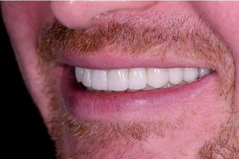 ¿Cómo colocar implantes en Valencia a pacientes con enfermedades periodontales? Clínica Viasalud