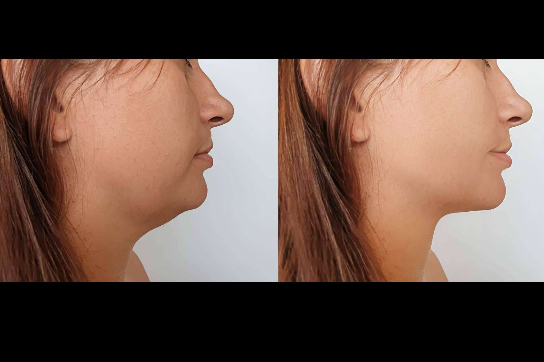 Eliminar la papada y la flacidez facial es posible con el lifting láser, de la mano de Clínica Femme