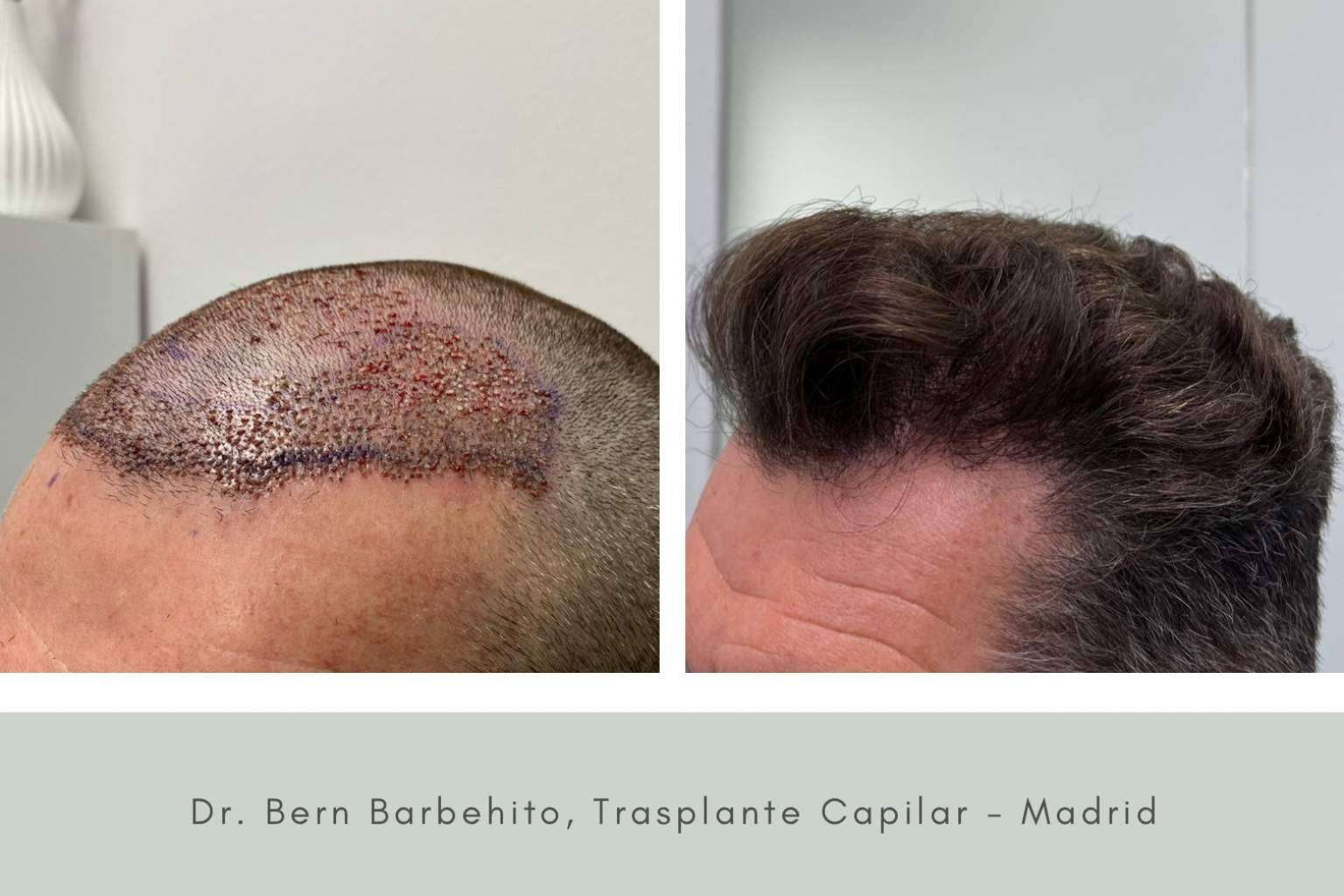 Todo lo que se debe saber sobre el postoperatorio de la cirugía capilar, según Doctor Bern