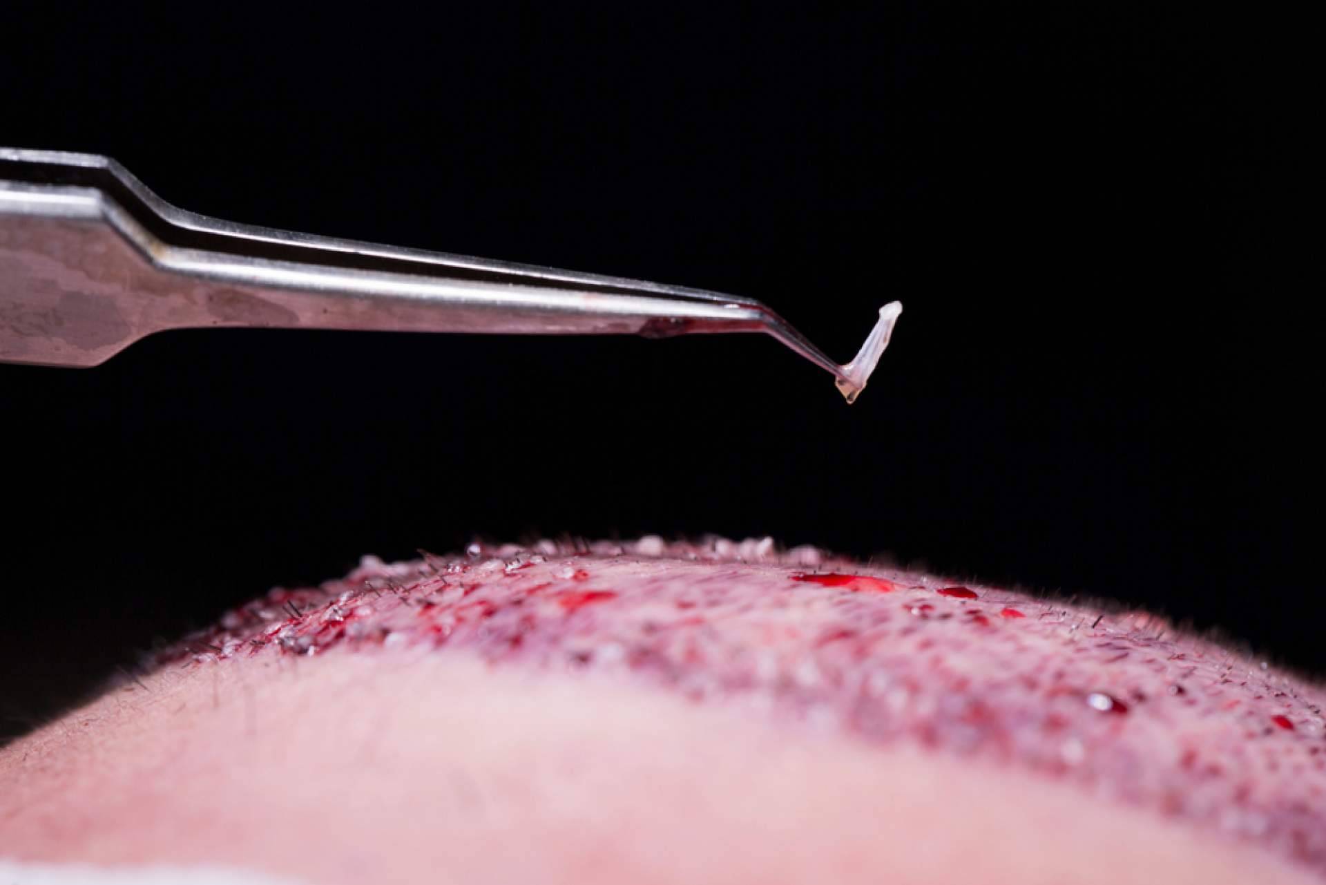 Todos los beneficios del plasma rico en plaquetas de la mano Élite Capilar