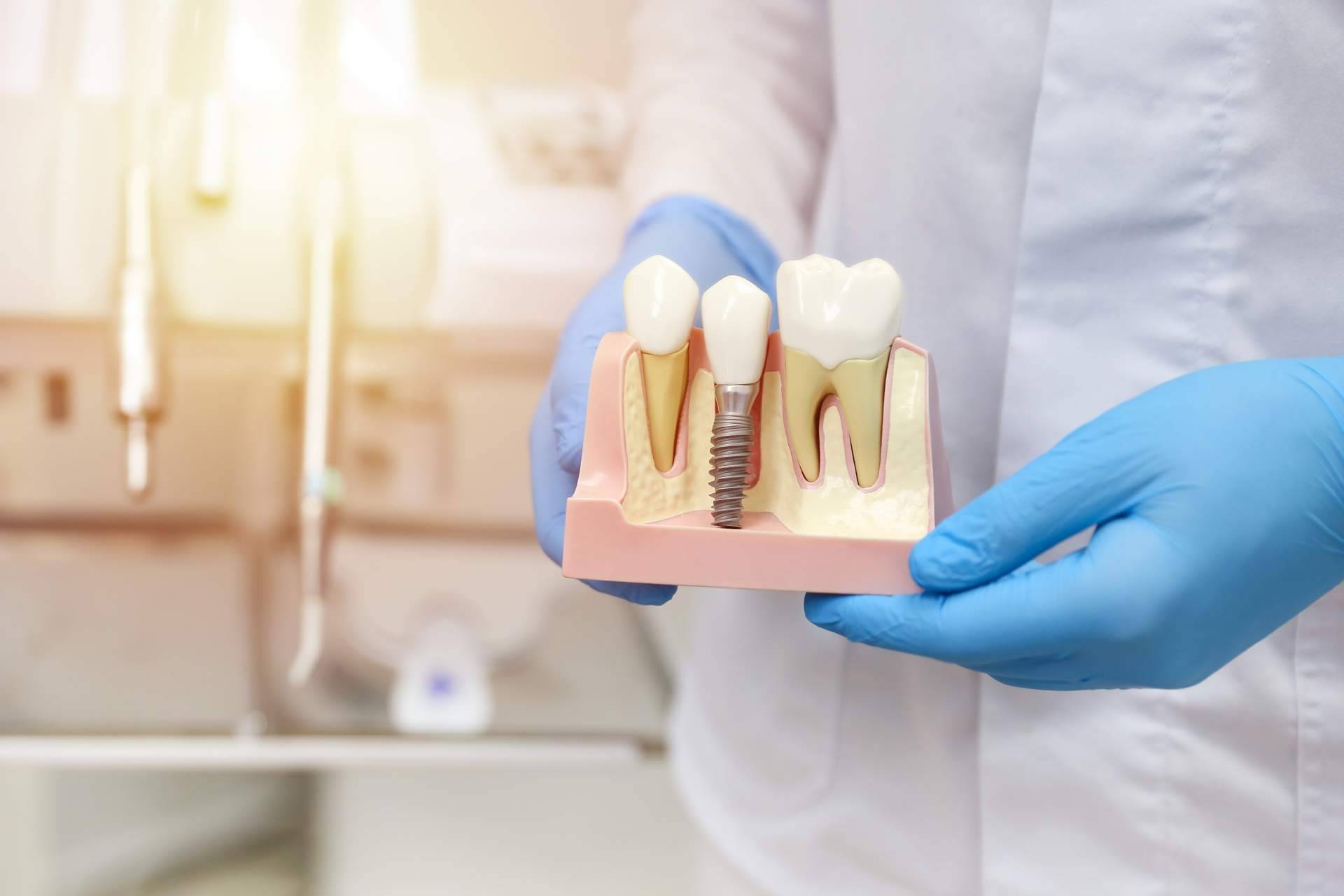 La técnica por la que apuesta Clínica Dental Sonrisas para conseguir una dentadura de 10 en sus pacientes, implantes postextracción con carga inmediata