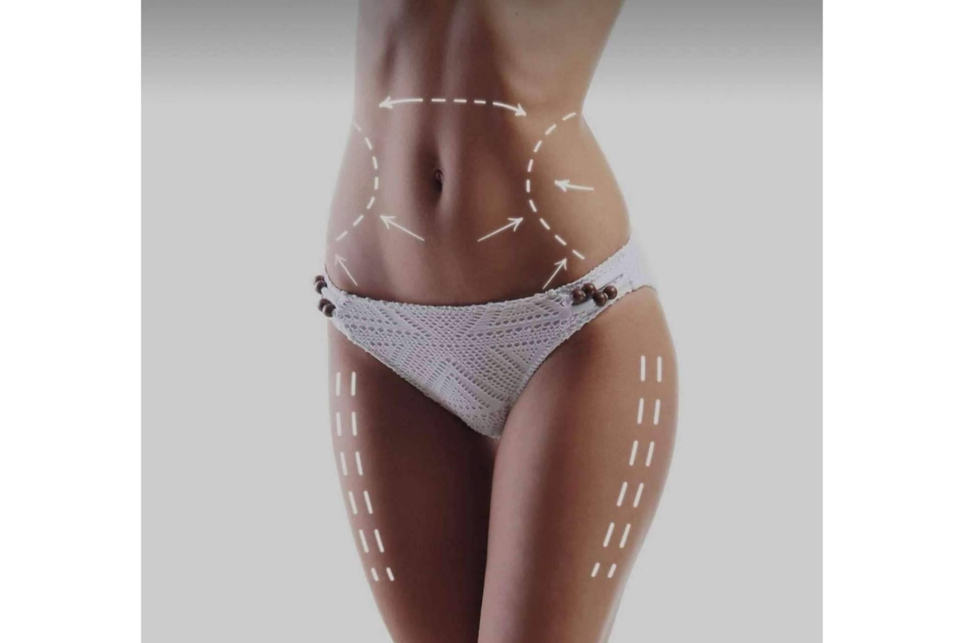 La mesoterapia corporal es el tratamiento de grasa localizada y celulitis ofrecido por la clínica de la Dra. Sánchez-Peral