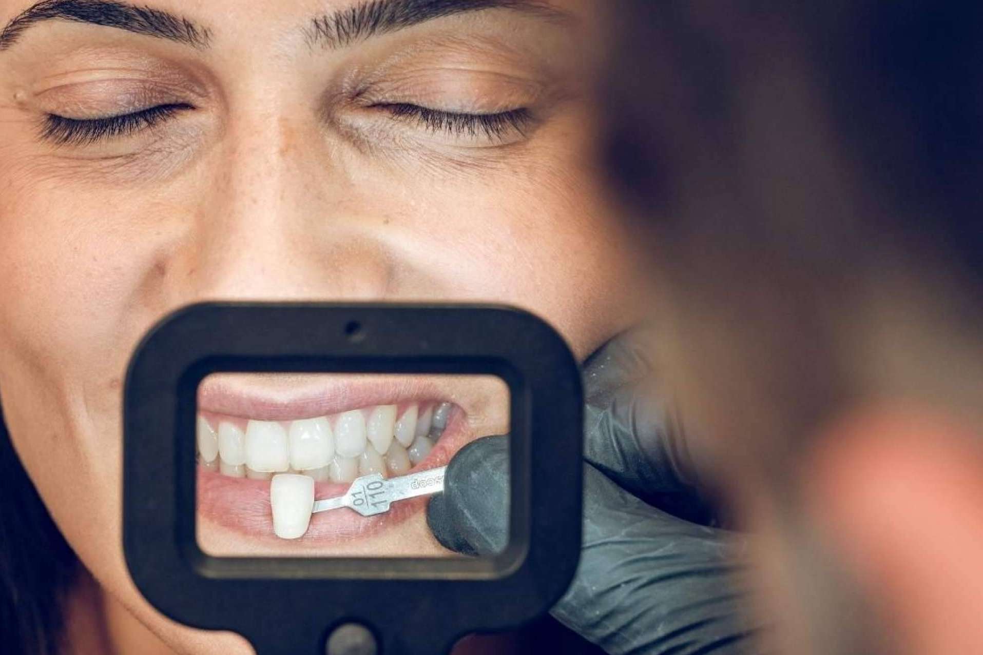 Todo lo que se debe saber sobre las carillas dentales, por Crespí & Gandía