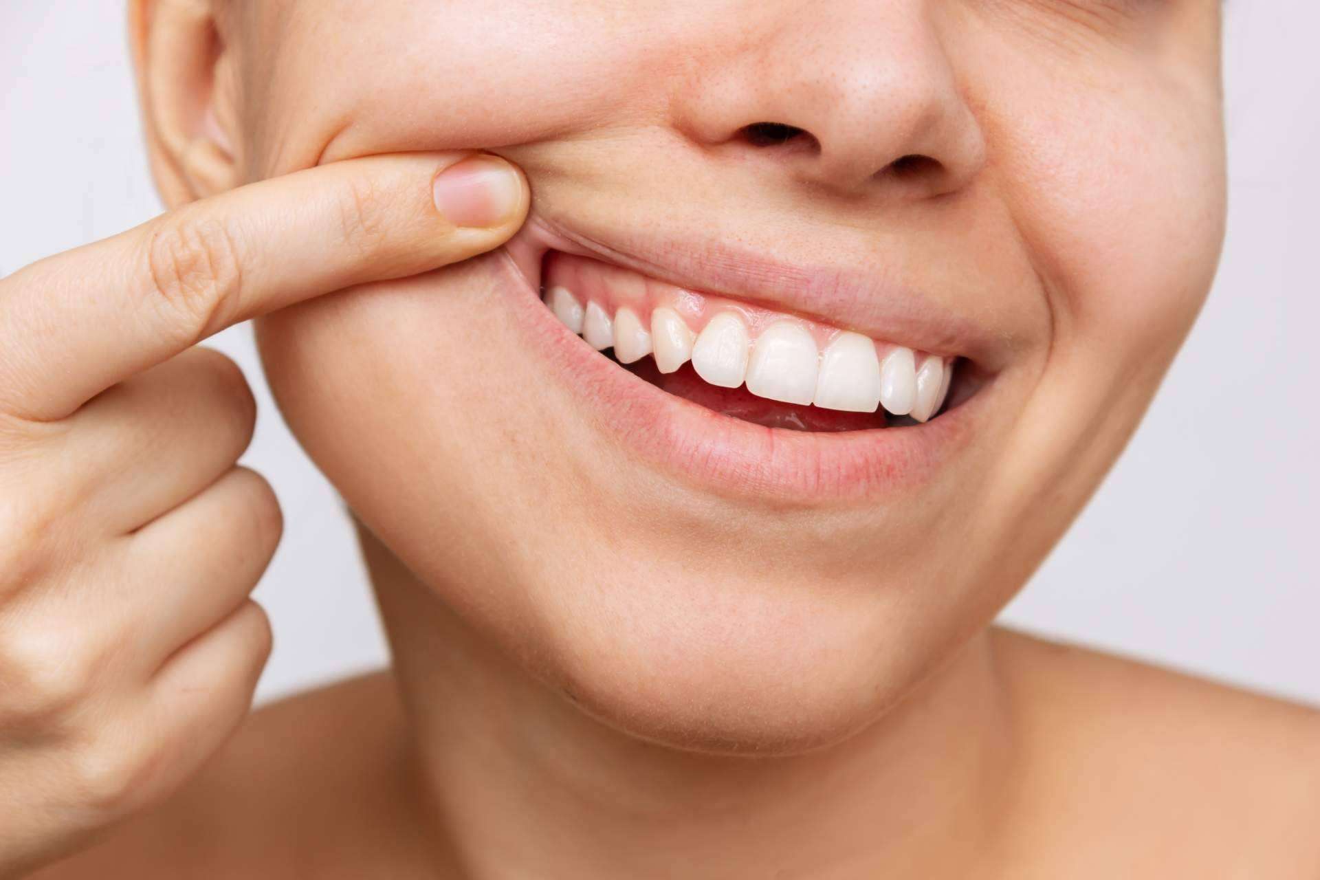 Mejorar el aspecto de una sonrisa con un blanqueamiento dental en las Clínicas Dental Bell