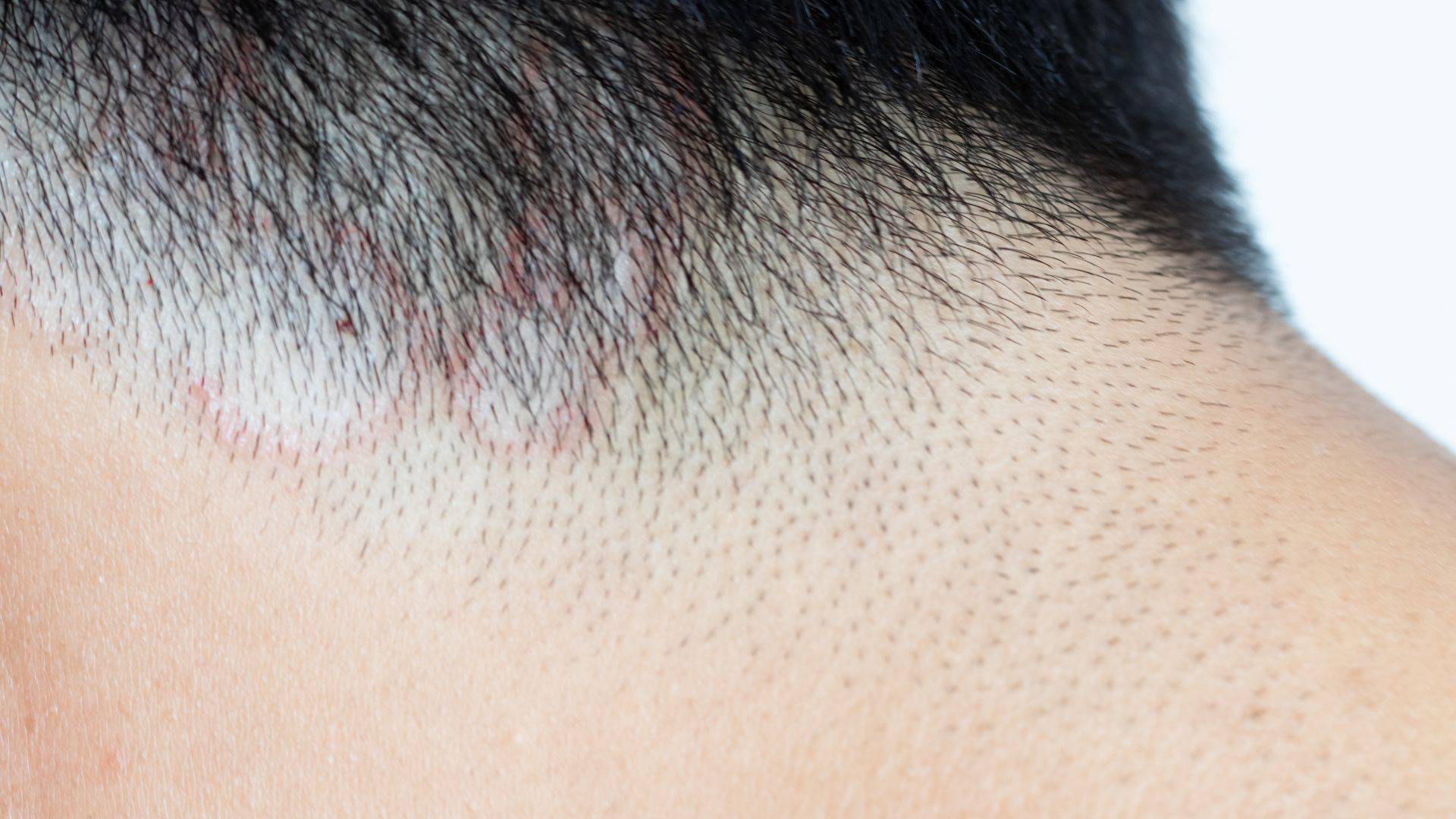 ¿La alopecia por tiña del cuero cabelludo puede ser contagiada por los perros?