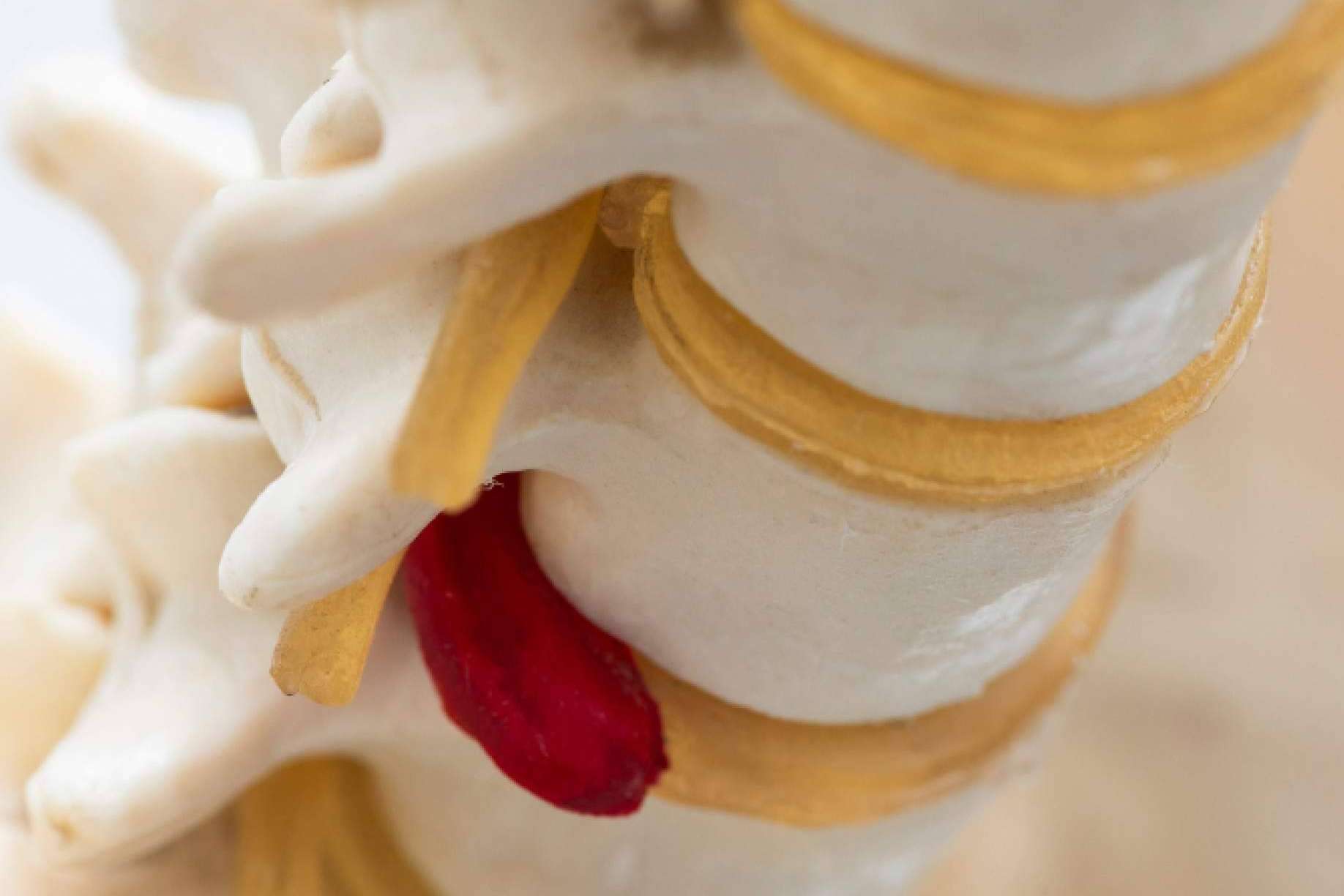 Las hernias de disco pueden mejorar sin necesidad de cirugía gracias a las últimas tecnologías avanzadas