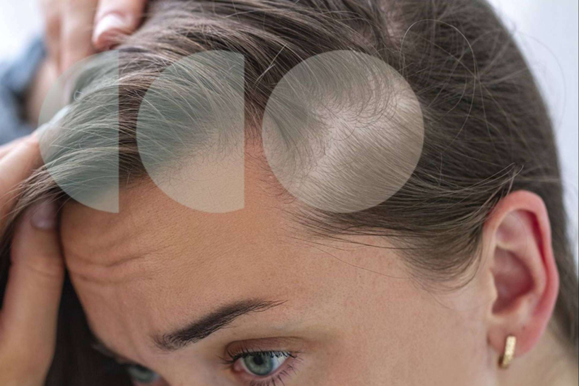 ¿Por qué la caída de cabello estacional viene más fuerte este año?