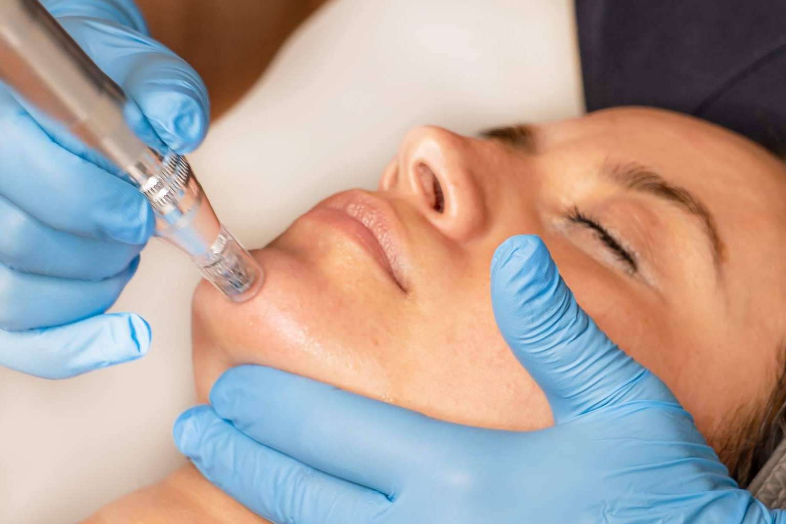 Realizarse un tratamiento innovador Dermapen Madrid en G&G Beauty