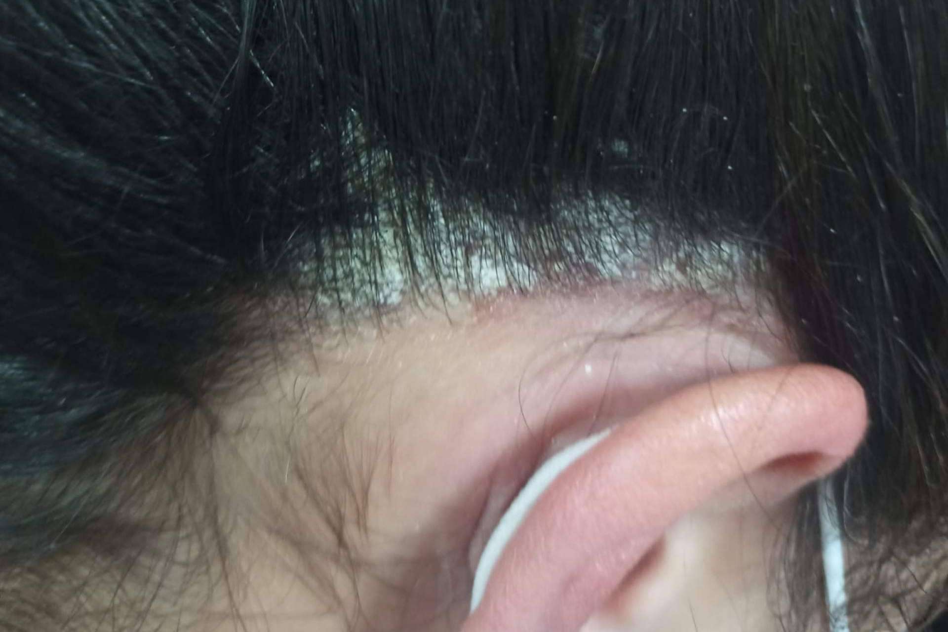 Tratando los problemas de la piel a través de la acupuntura y fototerapia, de la mano de Nüwa