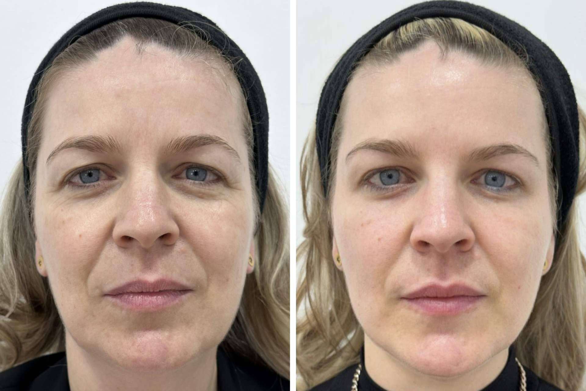 Mejorar la apariencia con los tratamientos faciales de Clínica VISO