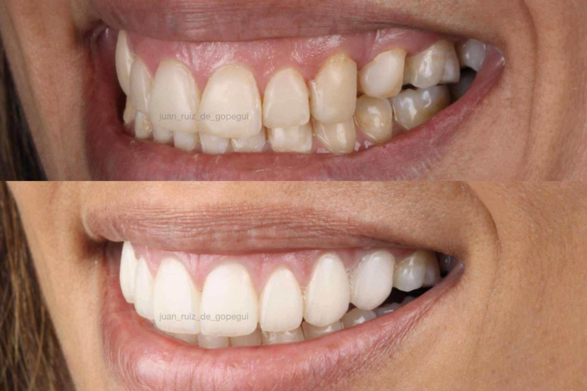 ¿Por qué elegir las carillas de porcelana para mejorar la sonrisa?