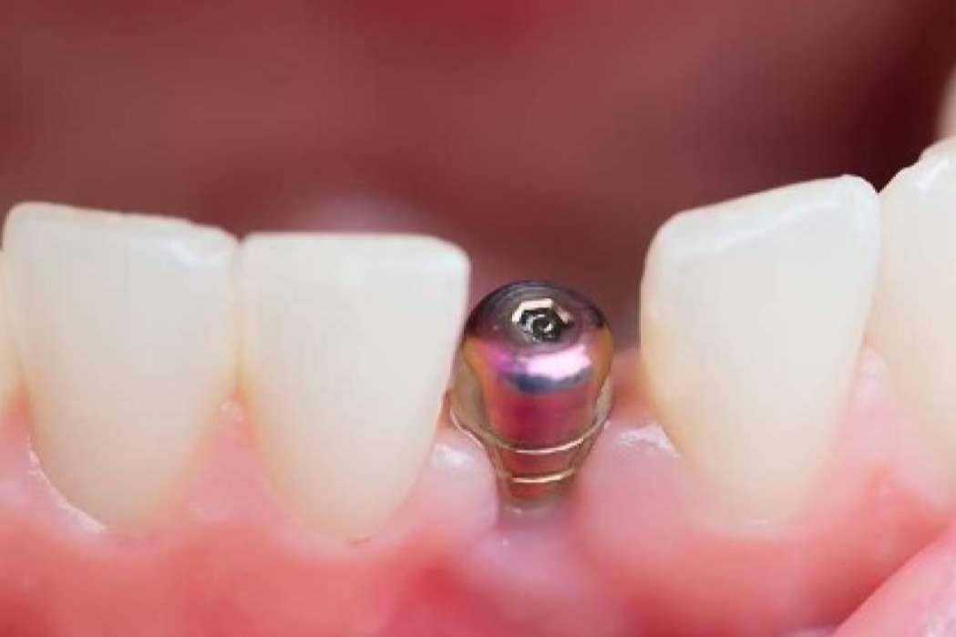 Todo sobre los implantes dentales de la Clínica Calvo de Mora