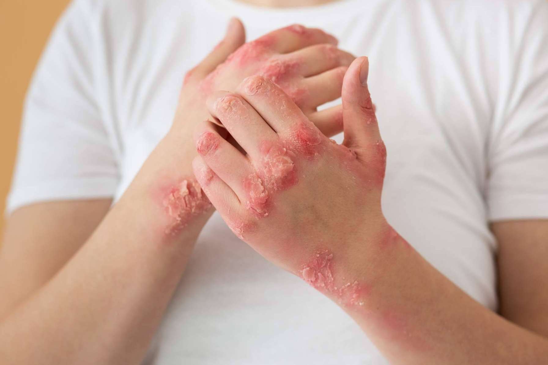 Los luchadores contra el eczema ahora cuentan con un superhéroe, Novopiel