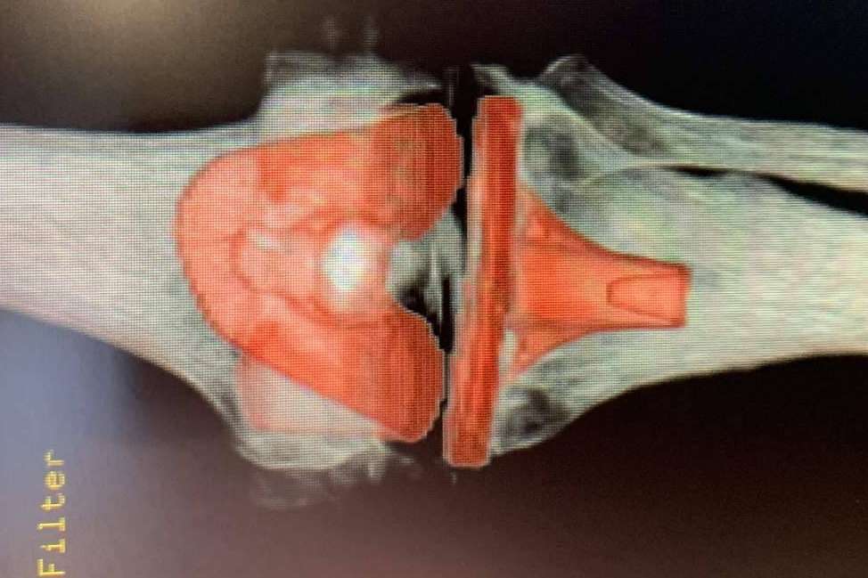 Tratamientos nuevos para la artrosis y retrasar el envejecimiento del cuerpo