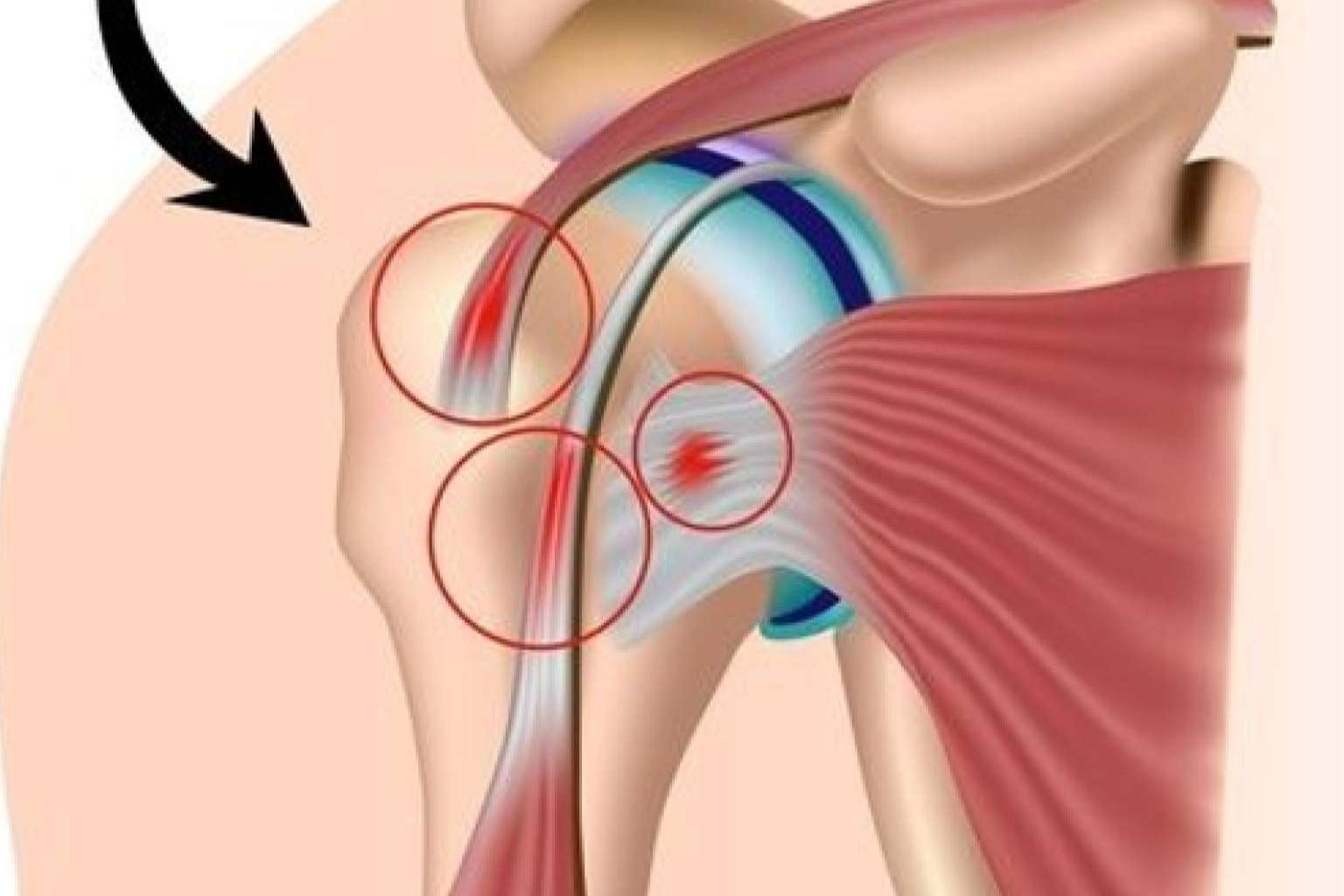 Biorigenera y sus tratamientos para el dolor de hombro