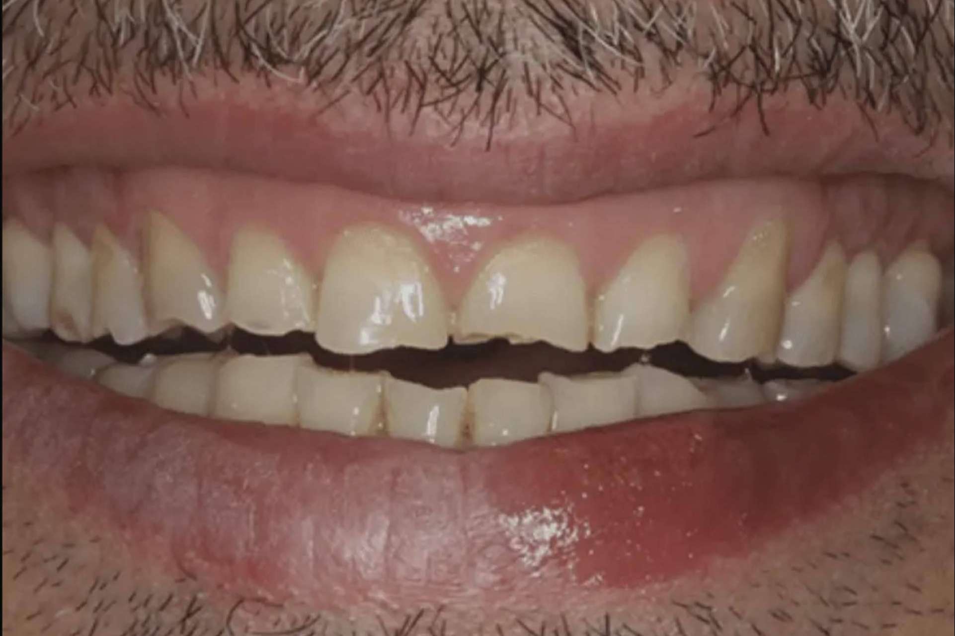 Síntomas, causas y tratamientos del bruxismo con especialistas de la Clínica Dental Nobel