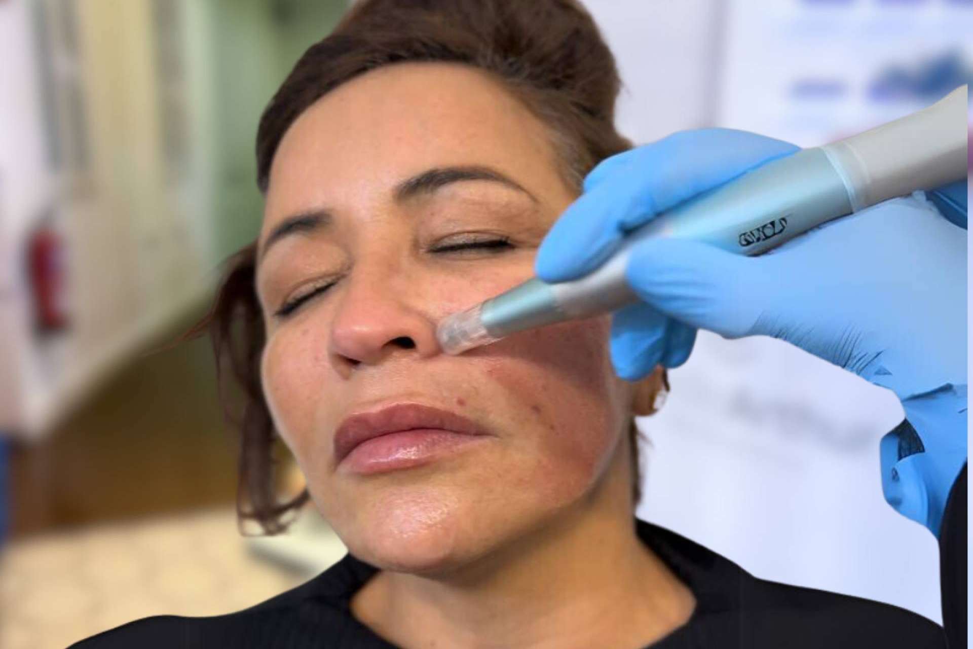 Clínica Cecilia Arthur, referente en tratamientos reparadores faciales post-verano