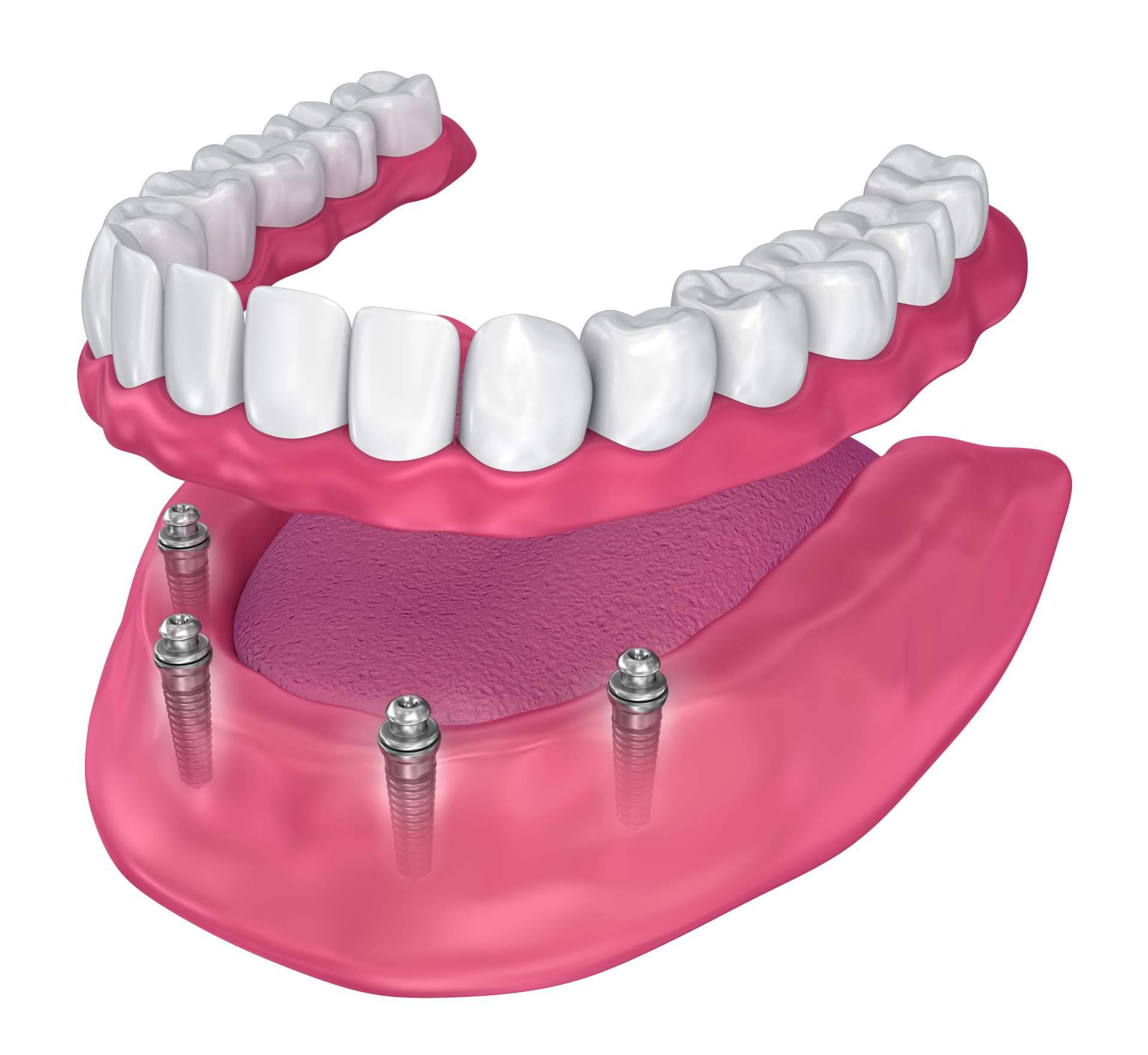 Clínica Dental Jorge del Corral, excelencia en implantología dental