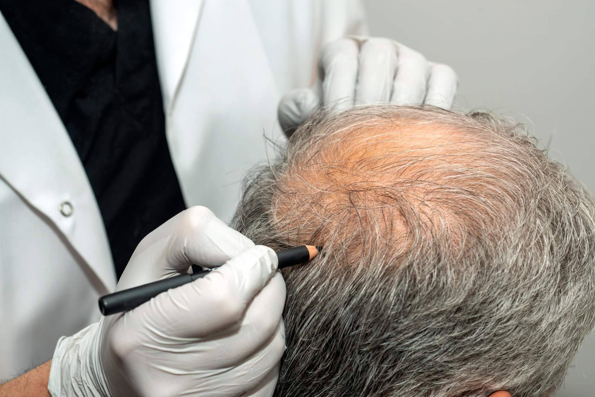 Última oportunidad antes del verano, trasplante capilar sin límite de folículos con el Dr. Jesús Aníbal Mora