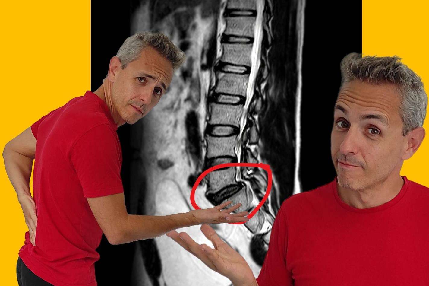 Roberto Galván destaca el enfoque más eficaz para el tratamiento de la hernia discal L5-S1