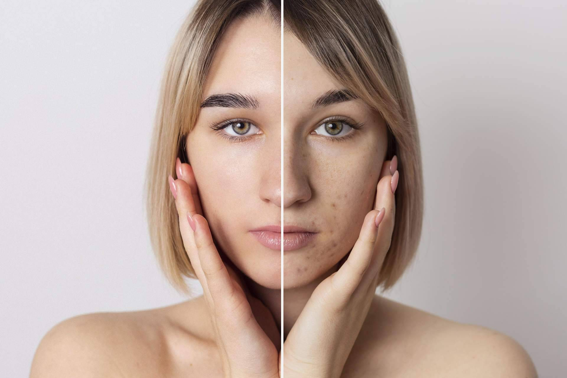 'Dermapen', el método de rejuvenecimiento cutáneo que marca tendencia en estética avanzada