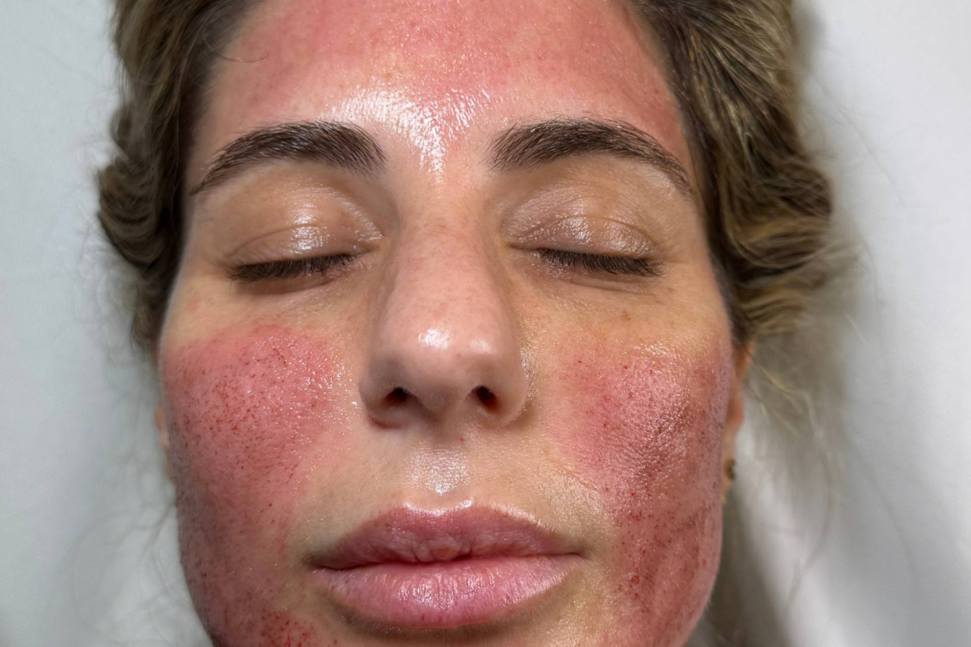 Vampiro facial, un procedimiento médico-estético para revitalizar la piel desde el interior